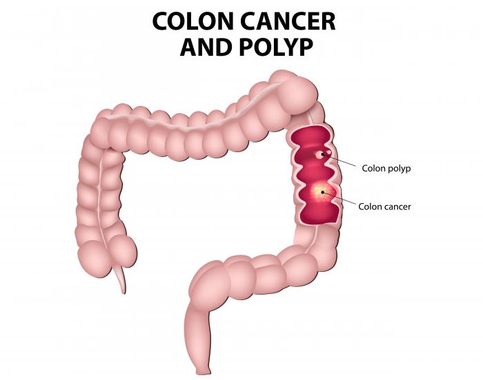 Having polyps increases the risk of colorectal cancer.