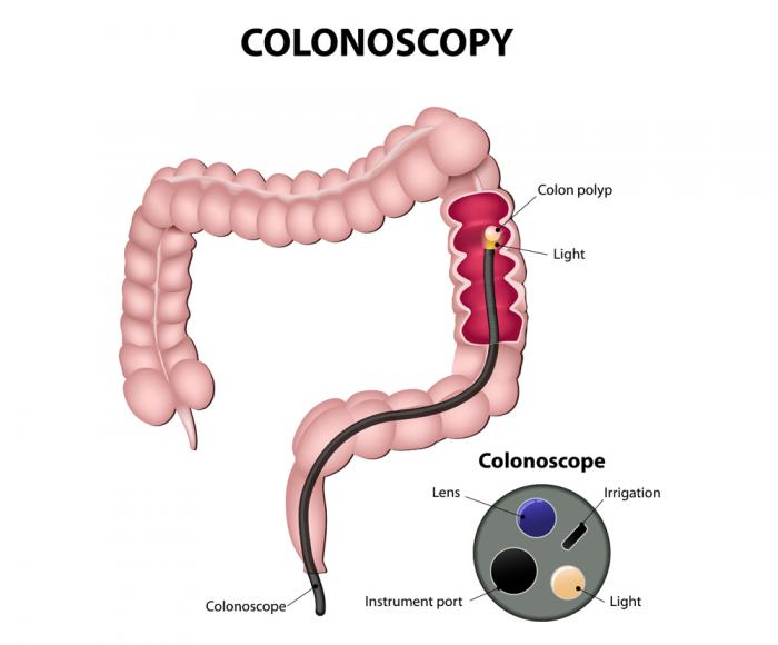 A diagram of the colonoscopy