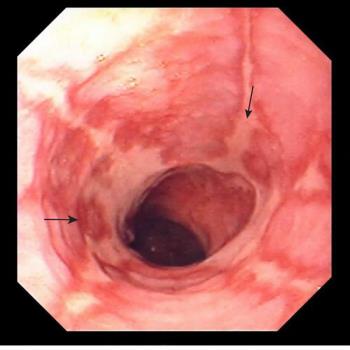 Esophagitis Caused by Gastroesophageal Reflux