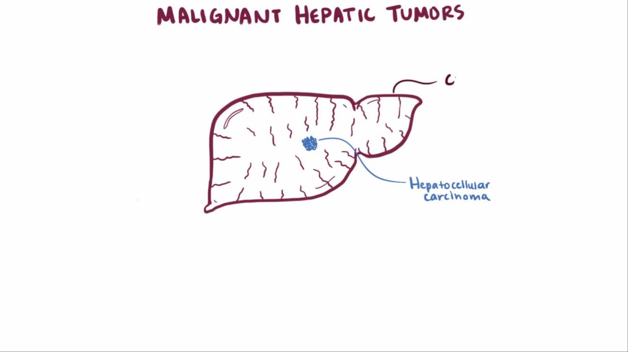 Overview of Hepatocellular Carcinoma