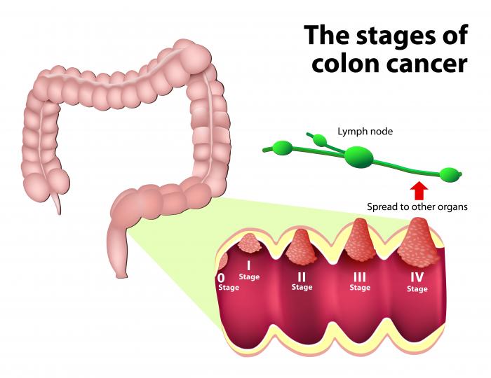 The stages of colon cancer