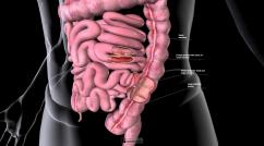 Intestinal Fistulas