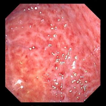 Chronic Gastritis