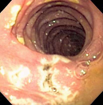 duodenum