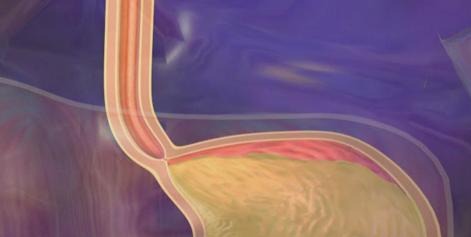 Gastroesophageal Reflux Disease