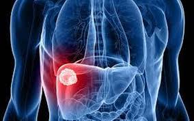 Metastatic Liver Cancer