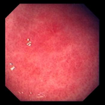 Acute Gastritis
