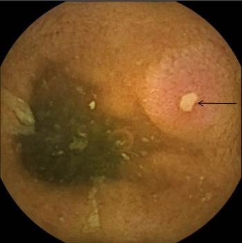 Ulcer in Crohn Disease